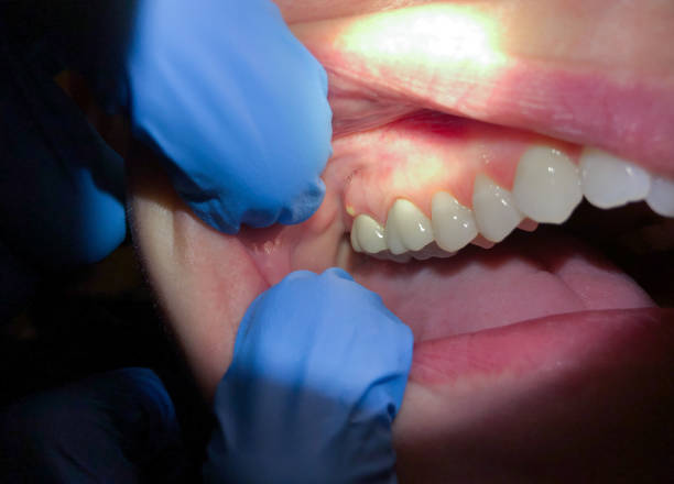 Best Emergency Dental Care for Broken or Chipped Teeth in Kellogg, ID