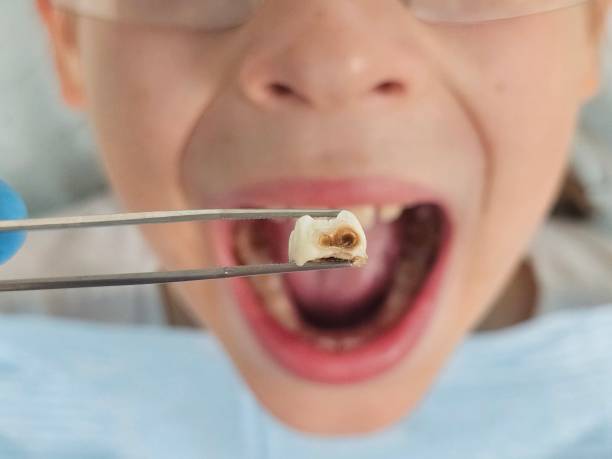 Best Emergency Tooth Extraction in Kellogg, ID
