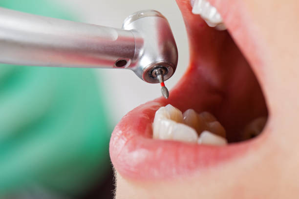 Best Emergency Tooth Extraction in Kellogg, ID